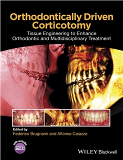 Orthodontically Driven Corticotomy, 1E 2015