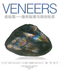 瓷贴面 隐形贴面与微创贴面