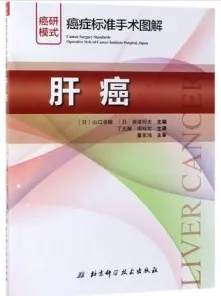 癌症标准手术图解 肝癌