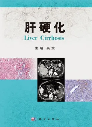肝硬化